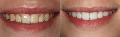Blanqueamiento dental con luz y láminas de porcelana, los métodos más eficaces para conseguir una sonrisa de anuncio