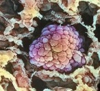 Se ensaya con éxito una vacuna cubana contra cáncer de pulmón