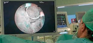Un nuevo método para detectar el cáncer de vejiga