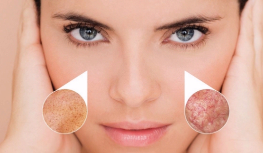 Luz pulsada para rejuvenecer tu piel