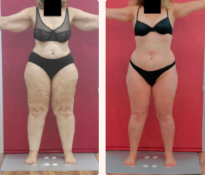 Todo sobre el lipedema, el gran desconocido que afecta a muchas mujeres