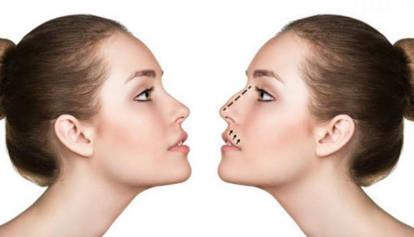Rinoplastia: la intervención ideal para dotar de armonía al rostro