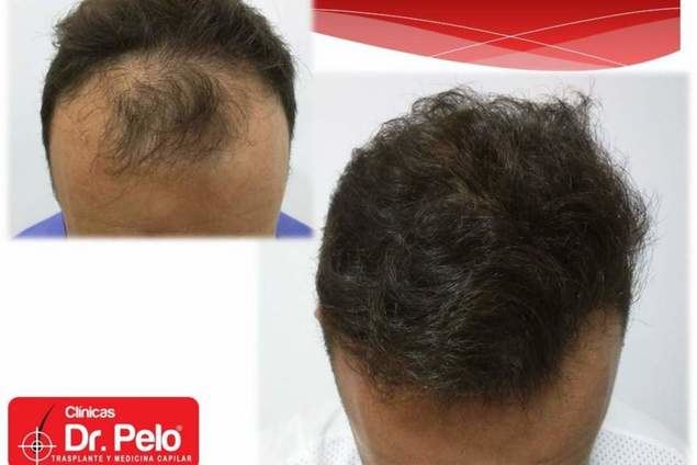 Dr. Pelo: el trasplante capilar, ¿La nueva tendencia en medicina estética?
