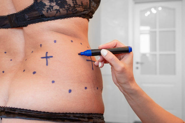 Aumenta un 25% la demanda de liposucciones y balones gástricos 