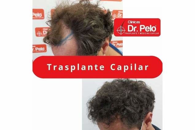 La mejoría en los precios y las técnicas aplicadas provoca el aumento de popularidad del transplante capilar en los últimos años en España
