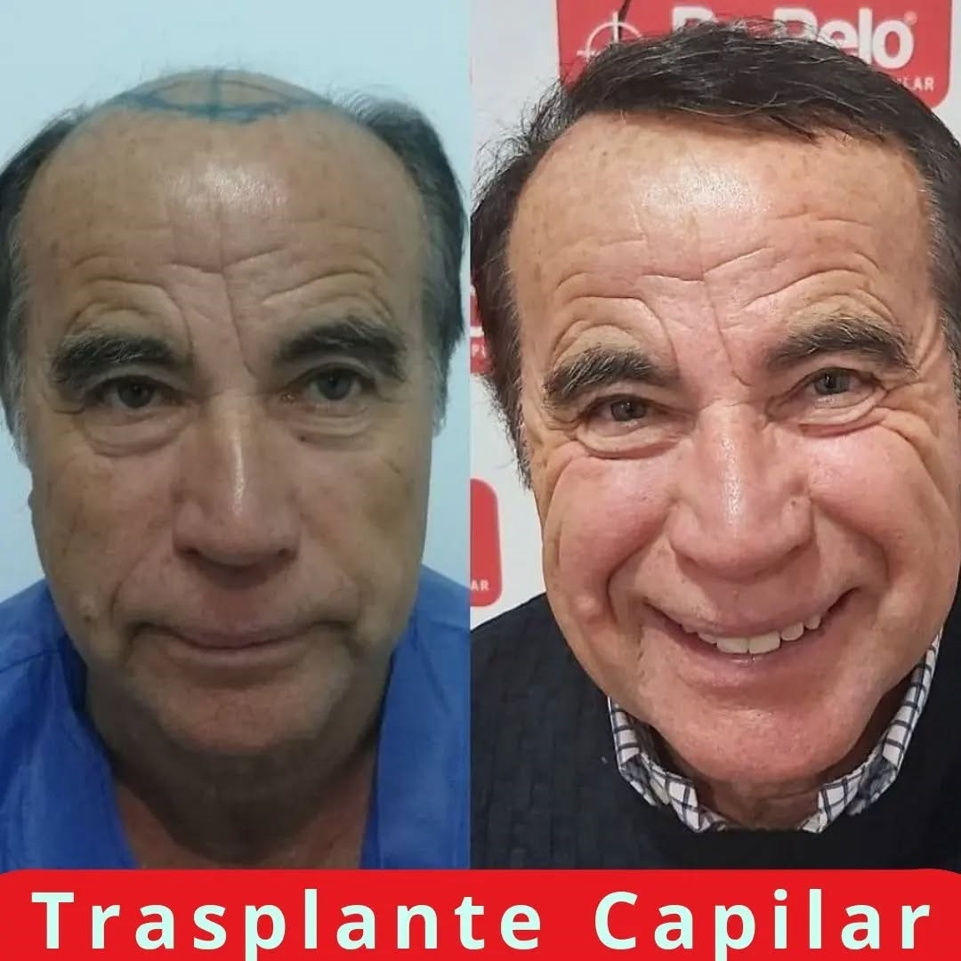 El reto de la calvicie avanzada: así es el injerto capilar más exigente que se realiza en Sevilla