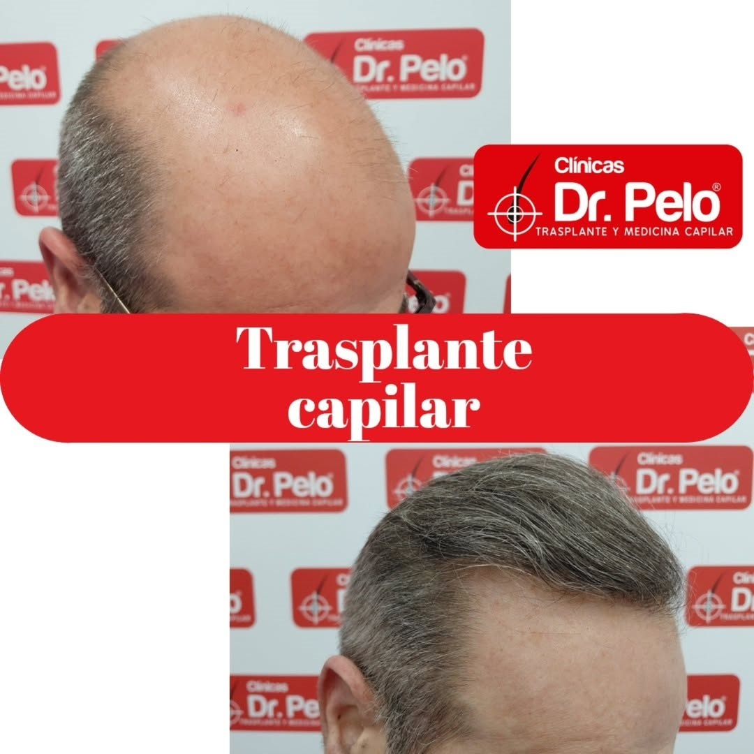 El reto de la calvicie avanzada: así es el injerto capilar más exigente que se realiza en Sevilla