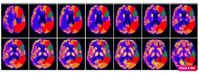 Neurocloud identifica y cuantifica de manera automática las zonas con un metabolismo anómalo respecto al de una persona sana. En la imagen las zonas coloreadas muestran zonas hipometabólicas anormales del cerebro de un paciente con demencia frontotemporal, dónde se pueden advertir mediante el código de colores diferentes grados de hipometabolismo lo que muestra que hay zonas más afectadas que otras