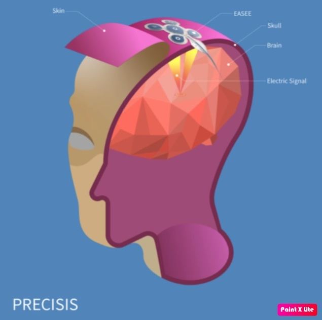 EASEE: el primer marcapasos cerebral mínimamente invasivo del mundo para el tratamiento de la epilepsia recibe la certificación CE y está disponible de inmediato