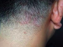 Tinea capitis, una infección del cuero cabelludo en ascenso en España desde el año 2021