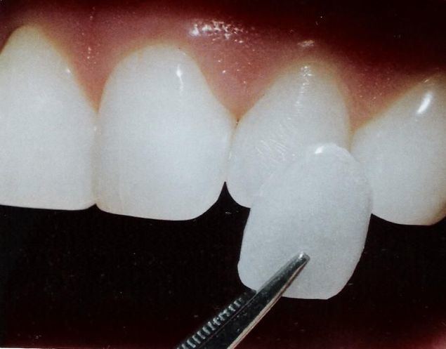 Las microcarillas dentales, una solución eficaz para alcanzar la sonrisa perfecta