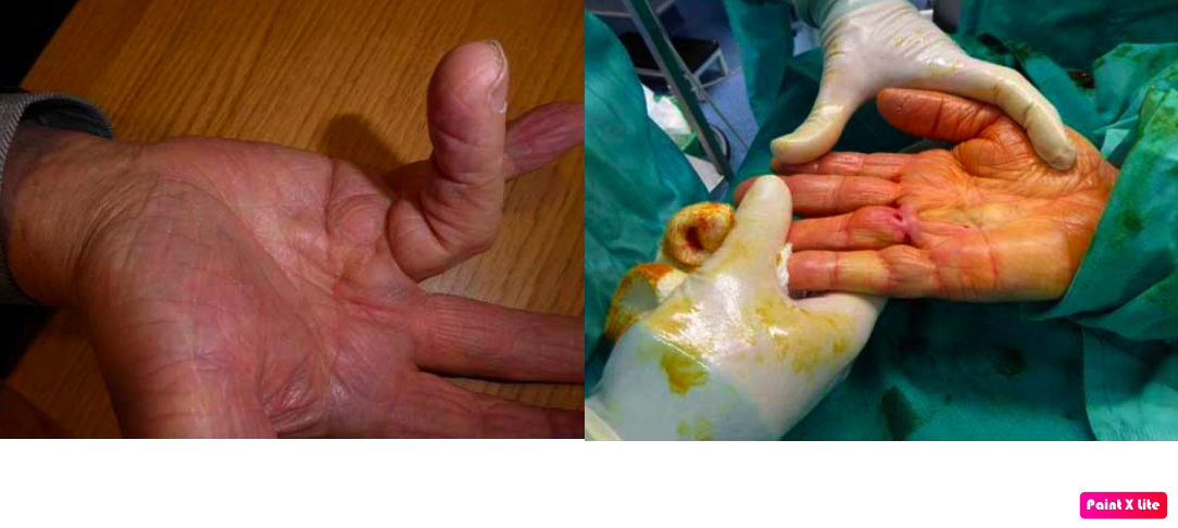 Cirugía ecoguiada para la enfermedad de Dupuytren: una alternativa menos invasiva para recuperar la función de la mano