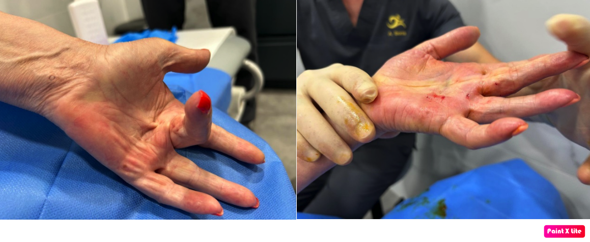 Mano izquierda, antes y después. Se aprecian los puntitos de perforación de la aguja para cortar la aponeurosis de la palma de la mano bajo control de ecografía.